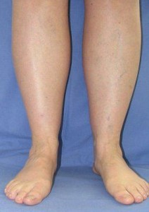 Geschwollenes Bein bei Venenerkrankung